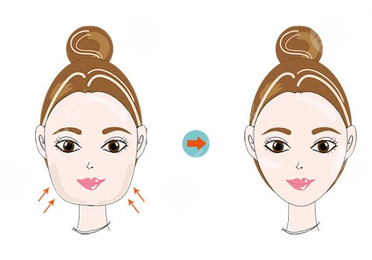  北京佰華利醫(yī)美面部吸脂案例