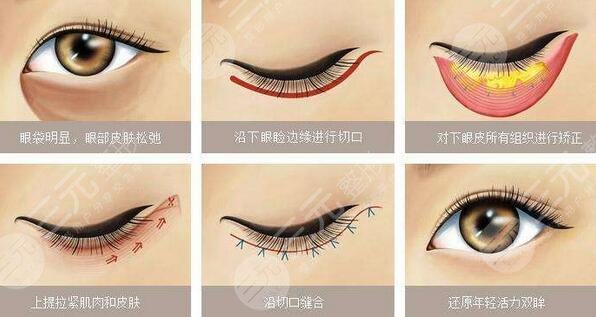 成都八大處祛眼袋真實案例果圖：術(shù)后3個月