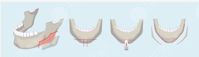 磨顴骨前后對(duì)比圖