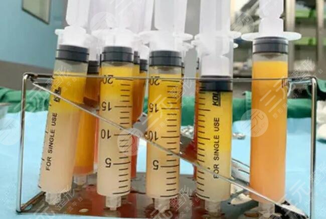 二次冷凍脂肪填充可靠嗎？