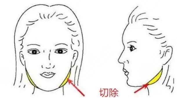 下頜角截骨手術(shù)原理