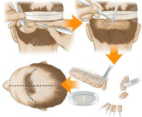 植發(fā)術(shù)后注意事項