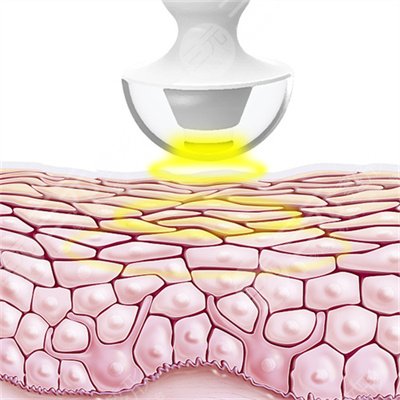 熱瑪吉做完老得更快是真的嗎？熱瑪吉原理果揭曉！熱瑪吉果