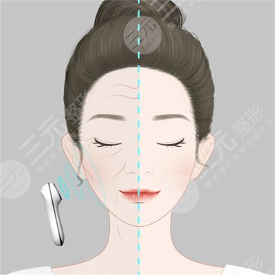 熱瑪吉做完老得更快是真的嗎？熱瑪吉原理果揭曉！注意事項(xiàng)