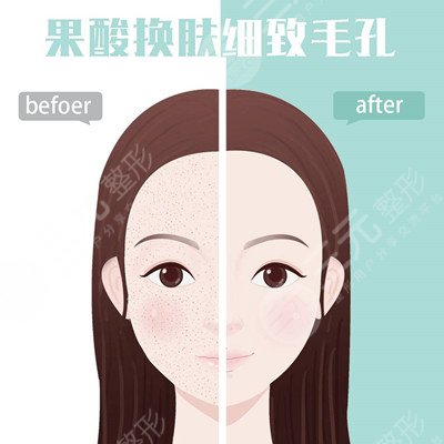 果酸換膚手術之后的半年