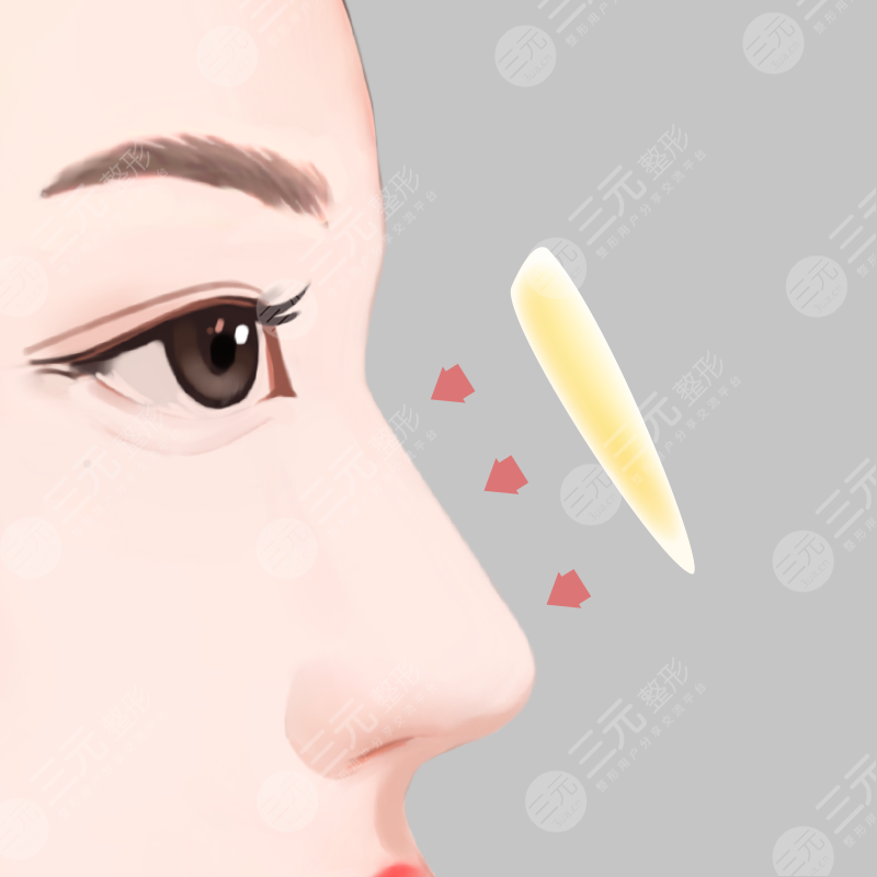 隆鼻術(shù)后的各種圖片