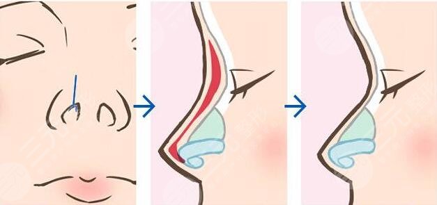 隆鼻術(shù)后的各種圖片