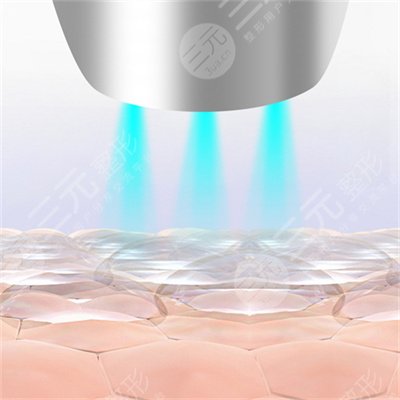 激光嫩膚一般多少錢？真實果圖