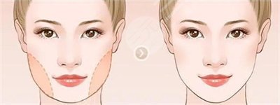 注射瘦臉價(jià)格多少錢一支