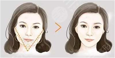 注射注射瘦臉術(shù)前照片