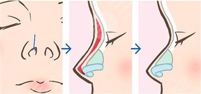 自體軟骨隆鼻術(shù)后注意事項