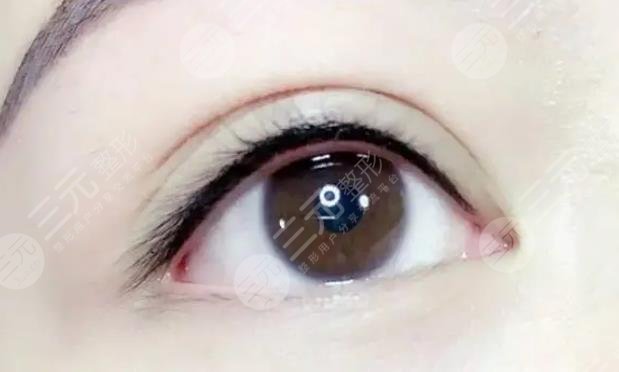 美瞳線一到七天恢復(fù)過程圖