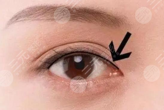 美瞳線一到七天恢復(fù)過程圖