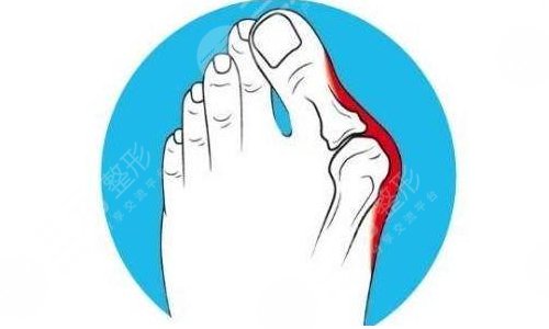 大腳骨外翻手術(shù)需要注意什么?