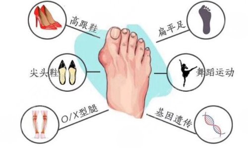 大腳骨外翻手術(shù)后如何護(hù)理?