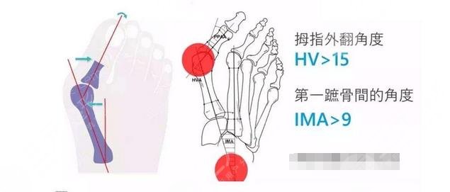 高跟鞋姐妹必看|大腳骨外翻怎么樣緩解？診斷依據(jù)+術(shù)后注意事項(xiàng)盤點(diǎn)！