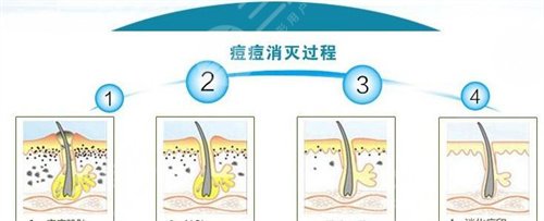 北京摩爾醫(yī)療美容激光祛痘案例