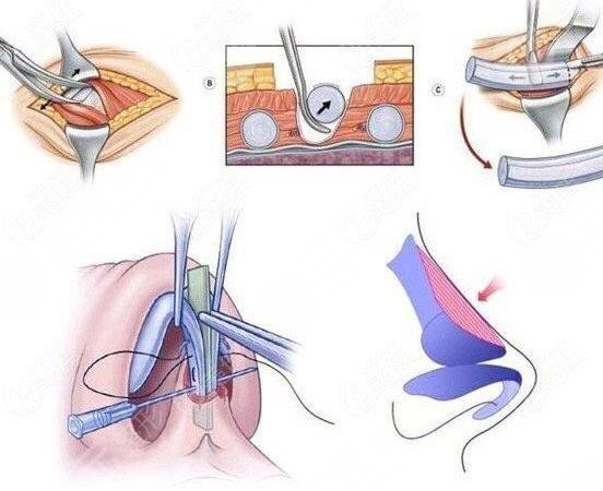 寧波郭光燁擅長項目科普：【肋軟骨隆鼻】