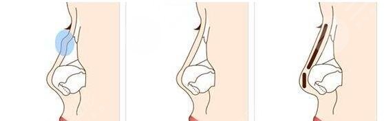 北京八大處隆鼻整形技術(shù)科普