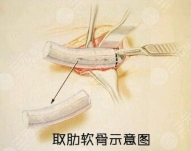 北京八大處肋軟骨隆鼻整形項(xiàng)目案例體驗(yàn)反饋：