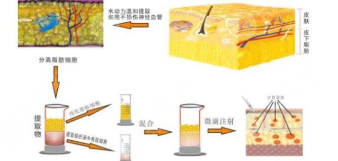 北京潤美玉之光做脂肪填充科普