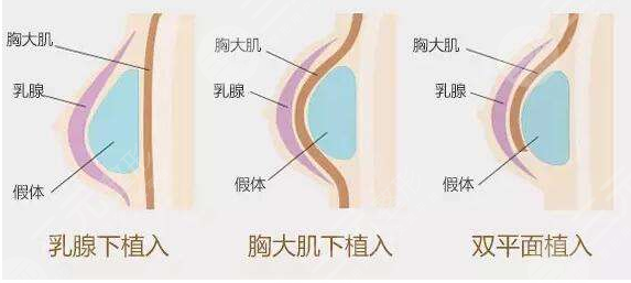 曼托隆胸術(shù)前需準(zhǔn)備什么？