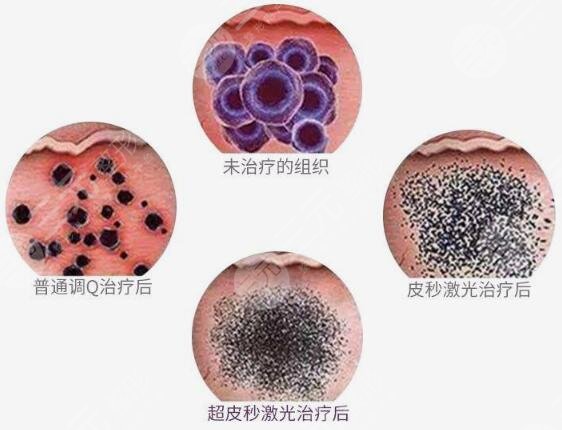 超激光美膚激光 果