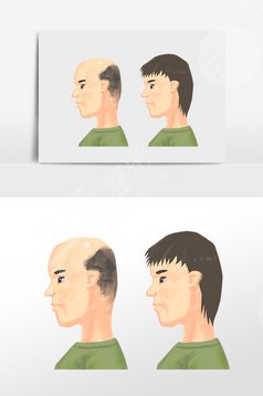 蘇州薇琳植發(fā)項目疑問解答