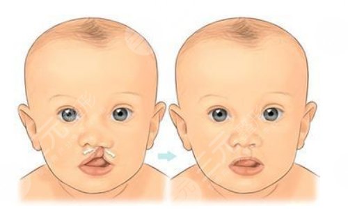 唇裂二次修復(fù)價(jià)格區(qū)間影響因素