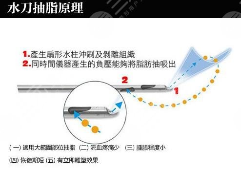水動(dòng)力吸脂原理