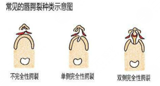 唇腭裂鼻子修復(fù)多大年齡合適？唇腭裂修復(fù)過(guò)程和時(shí)間需要多久？