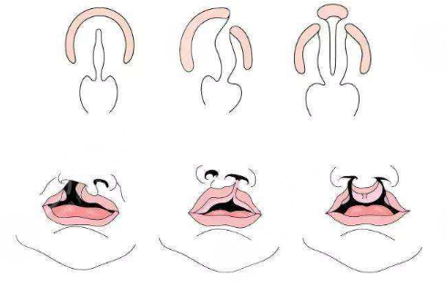 唇腭裂鼻子修復(fù)多大年齡合適？