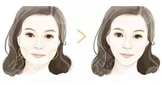 磨骨手術(shù)對(duì)比