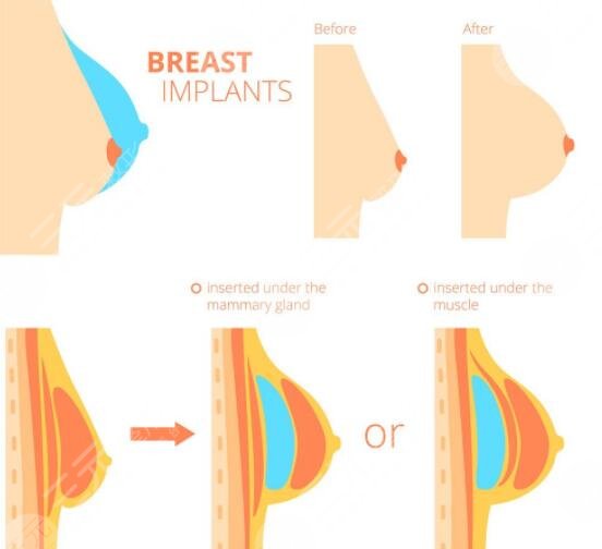假體隆胸手術(shù)術(shù)后要怎么護理?