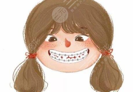 武漢金屬矯正牙齒案例