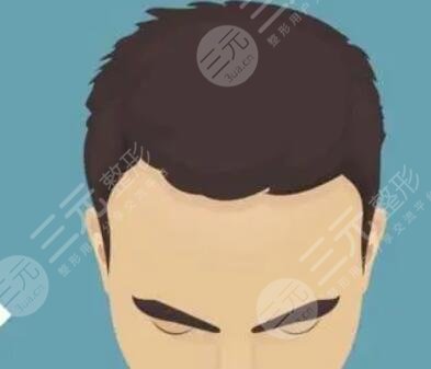 蘭州雍禾植發(fā)醫(yī)院發(fā)際線種植案例分享