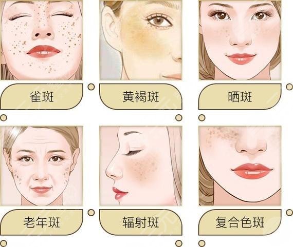 淮安市第一人民醫(yī)院激光祛斑網(wǎng)友親身體驗日記|案例:術(shù)前