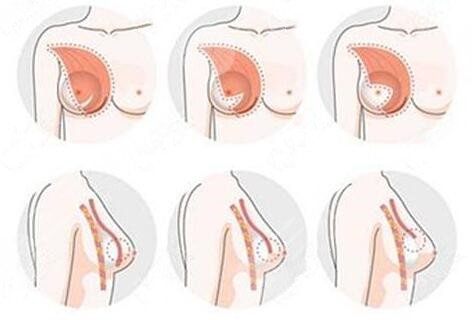 魔滴假體隆胸為什么價格有高有低？