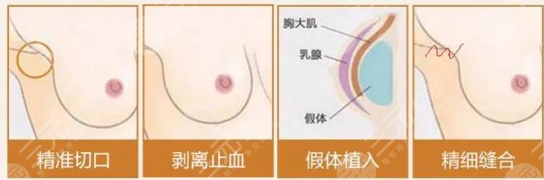 美國(guó)曼托假體