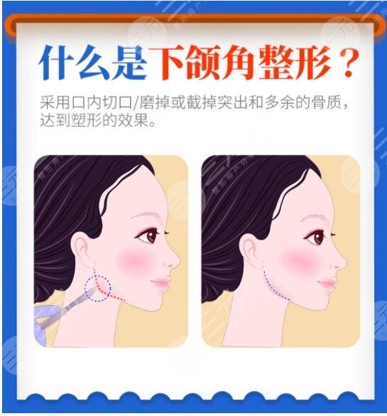 下頜角整形術(shù)有危險(xiǎn)嗎？費(fèi)用大概多少錢(qián)？?jī)r(jià)格表附上
