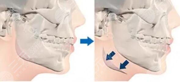 下頜角整形手術(shù)要注意什么?
