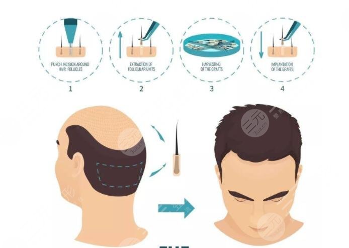 廣東省人民醫(yī)院植發(fā)項(xiàng)目科普