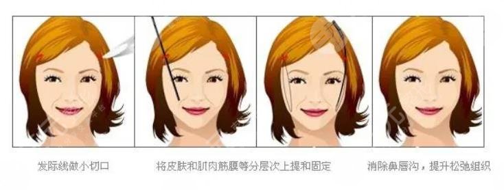 大拉皮手術15天照片