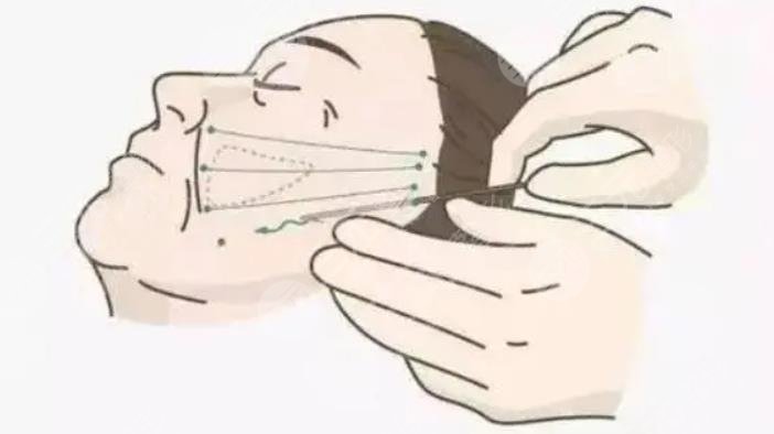 大拉皮手術15天照片