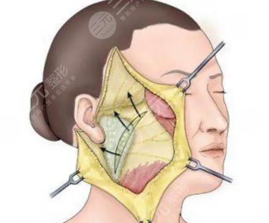 大拉皮手術15天照片