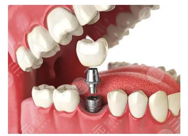 　牙齒種植體十大排名NO.9、埃克斯種植體