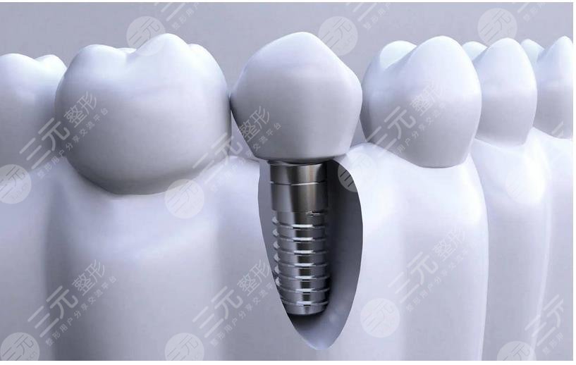 齒種植體十大排名NO.7、捷邁種植體