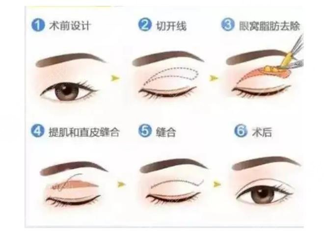 雙眼皮手術(shù)常見(jiàn)手法  　　1、埋線法