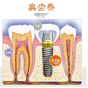 韓國奧齒泰種植牙多少錢一顆?