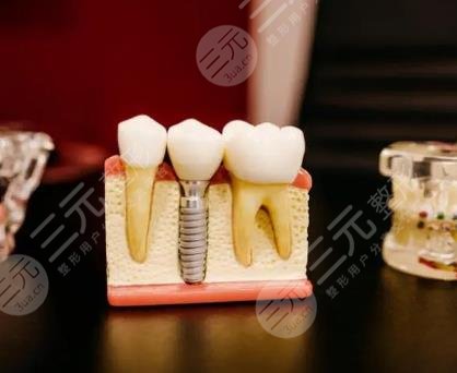 種植牙